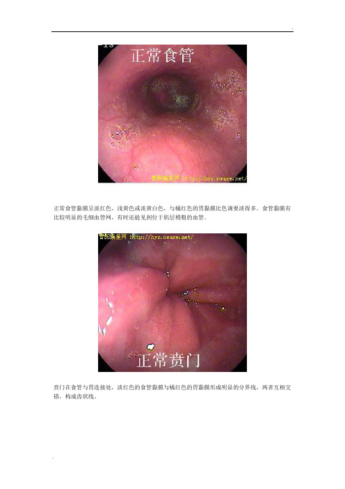 胃镜图片