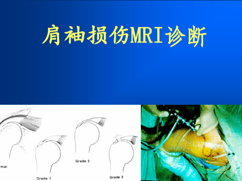 肩袖损伤MRI诊断新版本