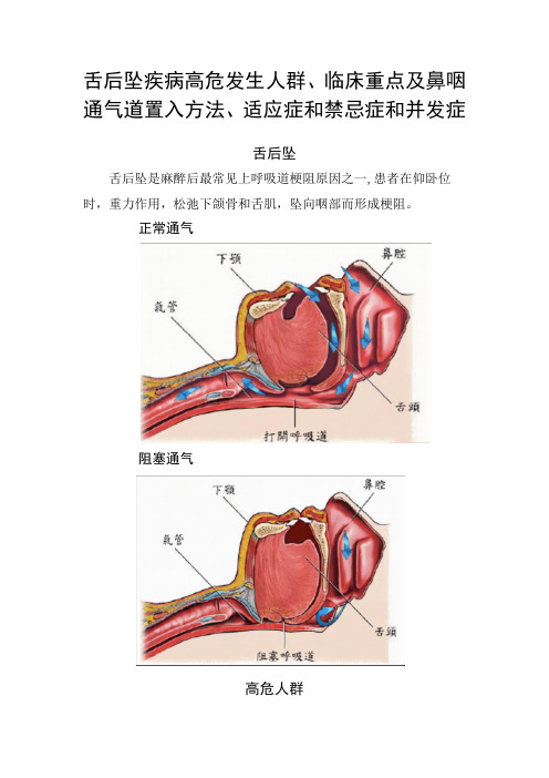 舌后坠疾病高危发生人群、临床重点及鼻咽通气道置入方法、适应症和禁忌症和并发症