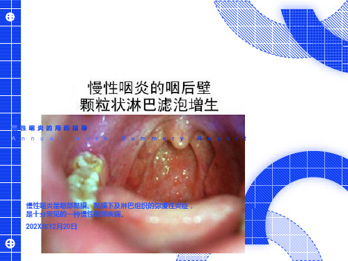 慢性咽炎的用药指导