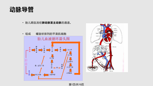 动脉导管未闭PPTPPT课件