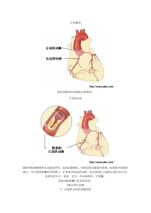 球囊扩张术