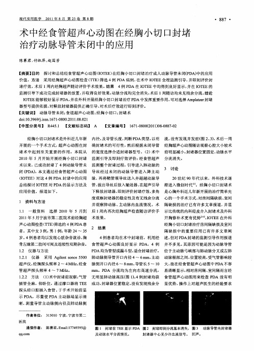 术中经食管超声心动图在经胸小切口封堵治疗动脉导管未闭中的应用