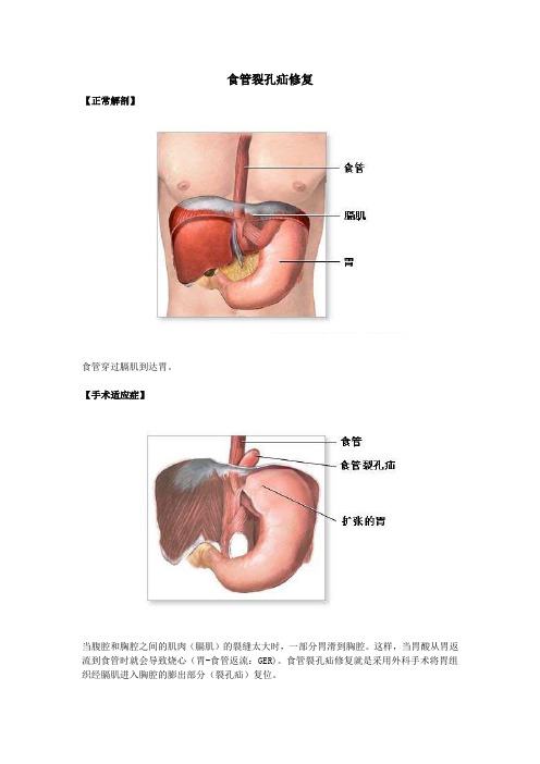 食管裂孔疝修复