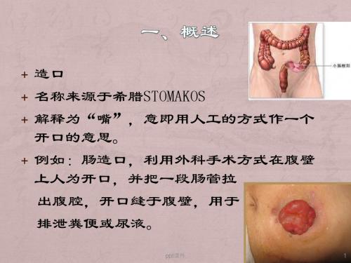 造口并发症的处理  ppt课件