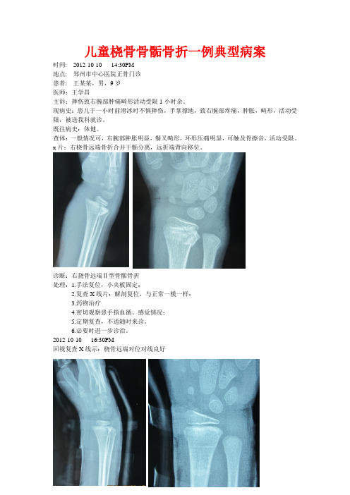 儿童桡骨远端骨骺骨折一例典型病案及点评