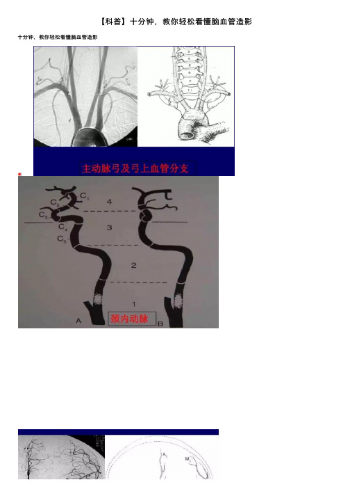 【科普】十分钟，教你轻松看懂脑血管造影