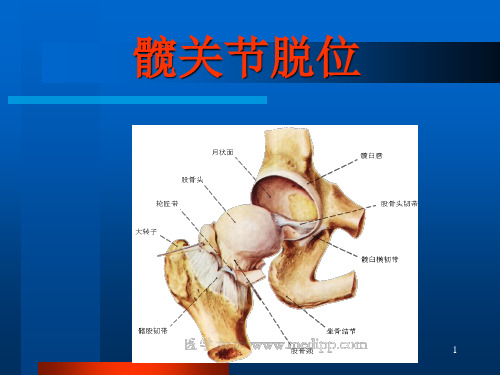 髋关节脱位ppt课件