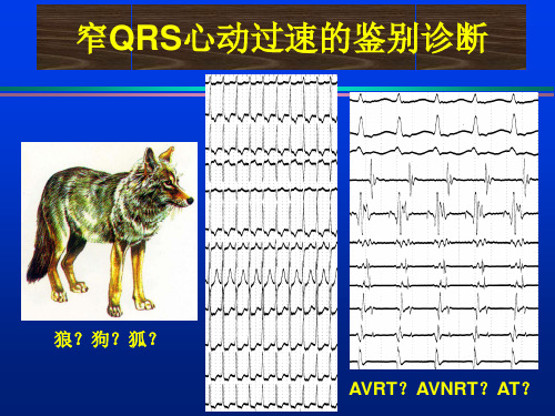 窄QRS波心动过速的鉴别诊断