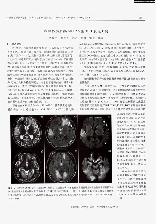 线粒体脑肌病MELAS型MRI表现1例