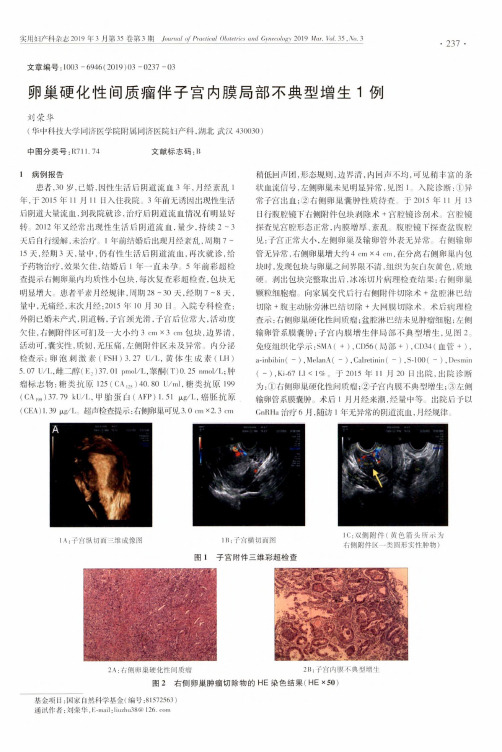 卵巢硬化性间质瘤伴子宫内膜局部不典型增生1例