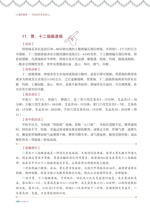 艾灸治疗常见病胃十二指肠溃疡胃下垂胃肠痉挛症慢性肠炎结肠炎腹泻细菌性痢疾慢性阑尾炎便秘便血疟疾