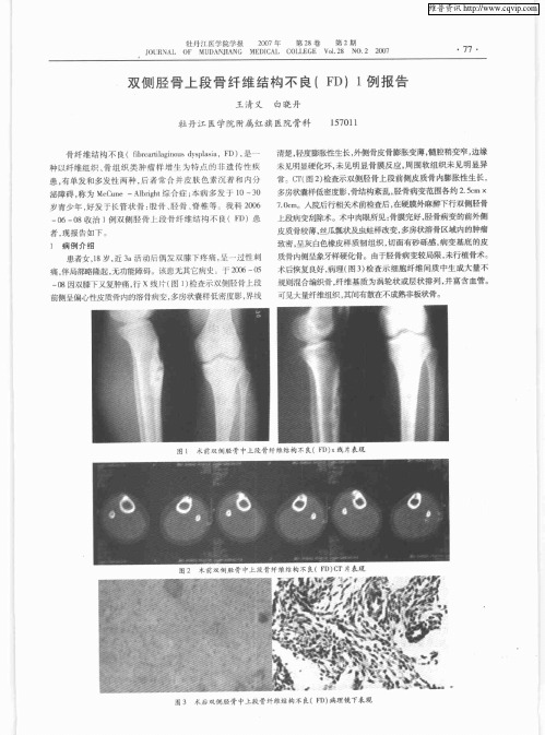 双侧胫骨上段骨纤维结构不良(FD)1例报告