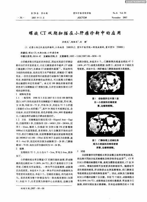 螺旋CT双期扫描在小肝癌诊断中的应用