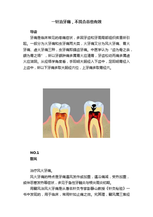 一针治牙痛，不找合谷也有效