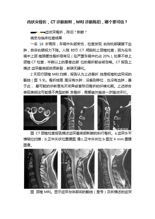 齿状突骨折，CT诊断新鲜，MRI诊断陈旧，哪个更可信？