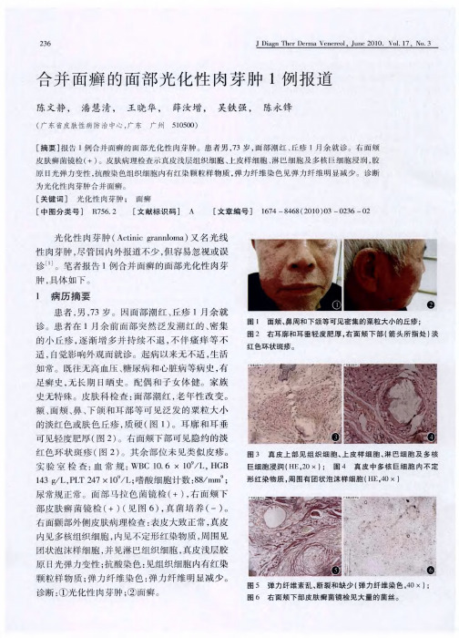 合并面癣的面部光化性肉芽肿1例报道