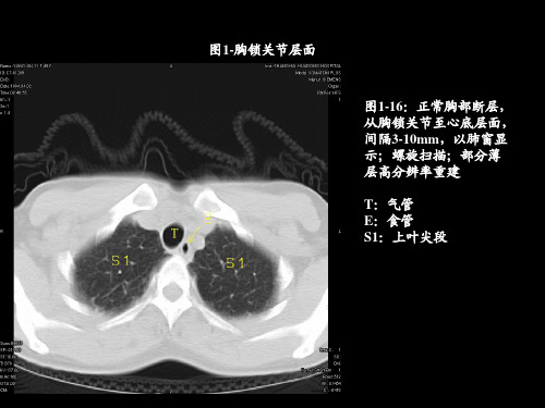 胸部CT的影像学表现