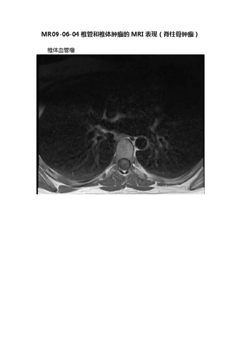 MR09-06-04椎管和椎体肿瘤的MRI表现（脊柱骨肿瘤）