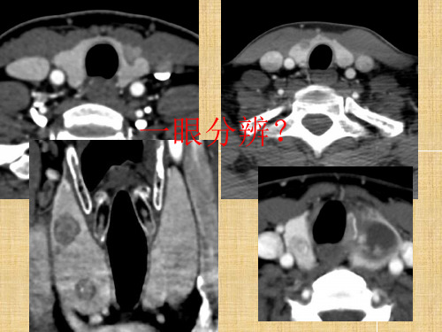 甲状腺乳头状癌CT征象