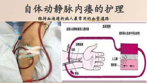 自体动静脉内瘘的护理  ppt课件