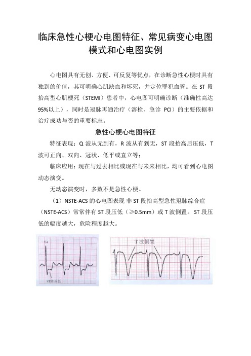 临床急性心梗心电图特征、常见病变心电图模式和心电图实例