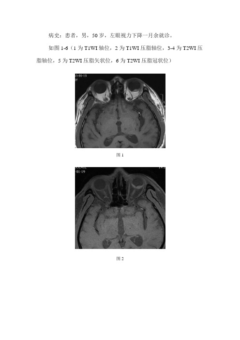 左侧眼球后壁丘状突起病变MRI影像诊断及鉴别诊断--左侧视网膜剥离合并出血