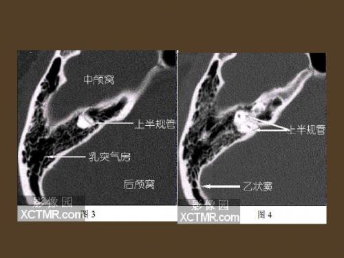 耳部CT解剖讲诉