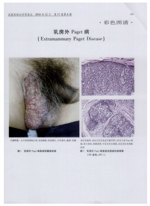 乳房外Paget病