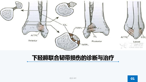 下胫腓联合韧带损伤课件