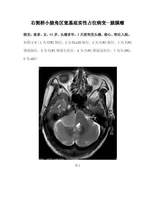 右侧桥小脑角区宽基底实性占位病变--脑膜瘤