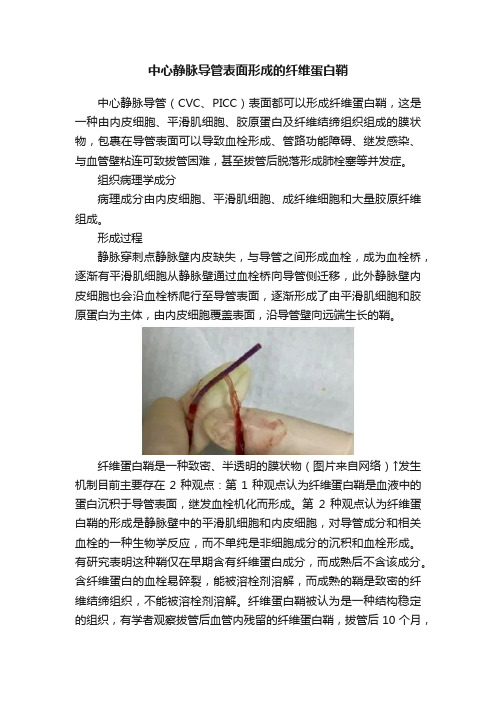 中心静脉导管表面形成的纤维蛋白鞘