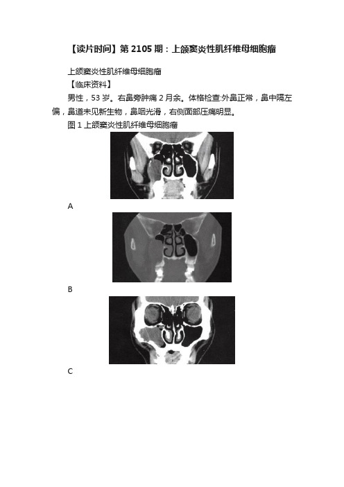 【读片时间】第2105期：上颌窦炎性肌纤维母细胞瘤