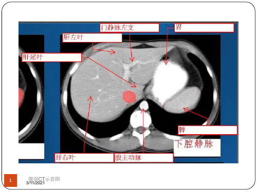 腹部CT示意图培训课件