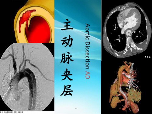 主动脉夹层pptppt课件
