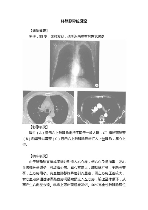 肺静脉异位引流