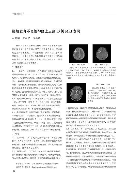 胚胎发育不良性神经上皮瘤13例MRI表现