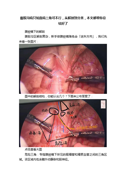 腹股沟疝只知直疝三角可不行，从解剖到分类，本文都帮你总结好了