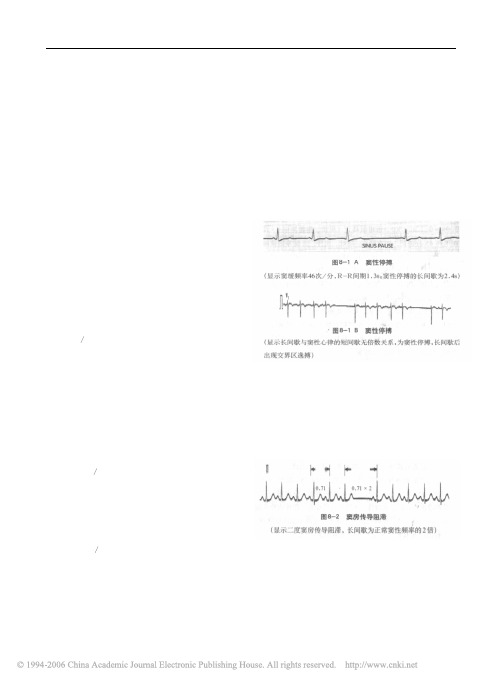 临床实用心电图入门  第八讲  病态窦房结综合征