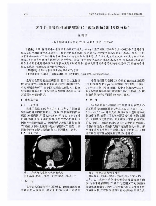 老年性食管裂孔疝的螺旋CT诊断价值(附16例分析)