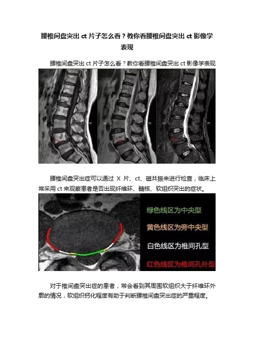 腰椎间盘突出ct片子怎么看？教你看腰椎间盘突出ct影像学表现