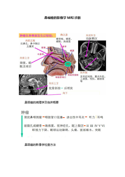 鼻咽癌的影像学MRI诊断