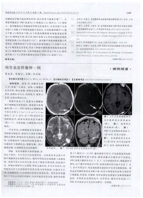 颅骨表皮样囊肿一例