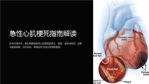 急性心肌梗死指南解读