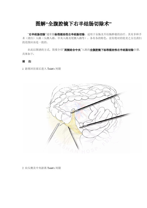 图解腹腔镜右半结肠切除