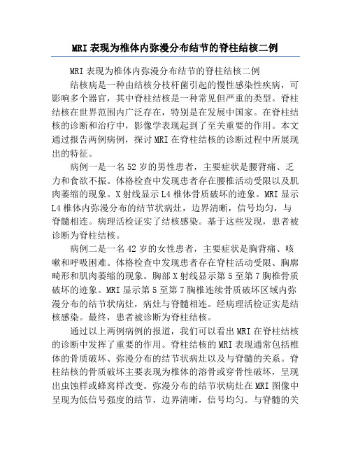 MRI表现为椎体内弥漫分布结节的脊柱结核二例