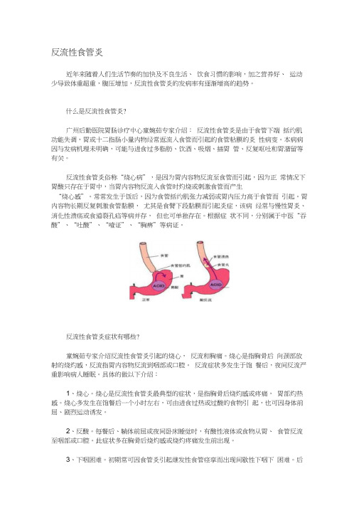 反流性食管炎