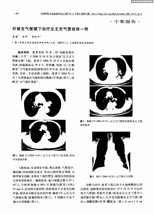 纤维支气管镜下治疗左主支气管结核一例