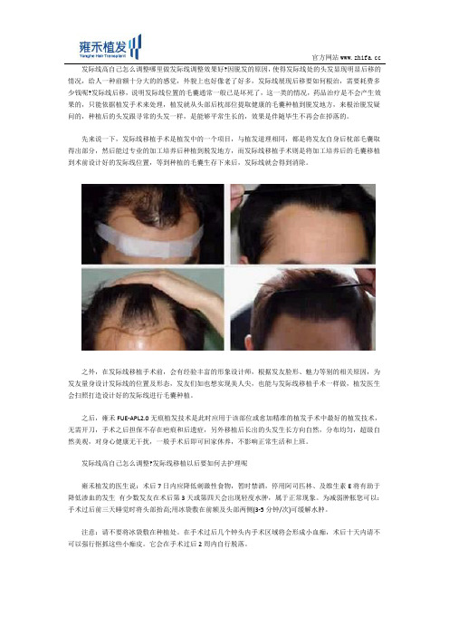 发际线高自己怎么调整哪里做发际线调整效果好