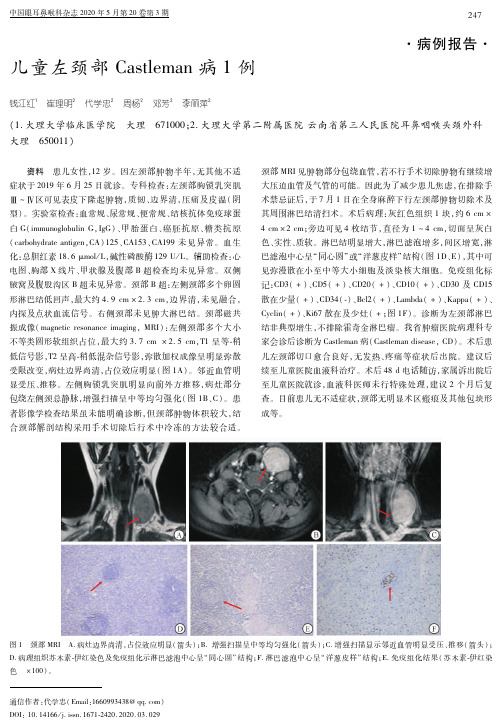 儿童左颈部Castleman病1例